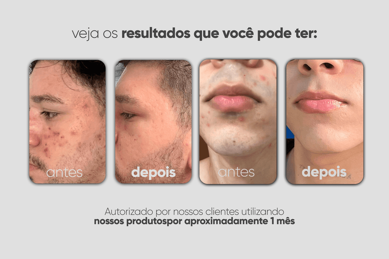 Kit Antiacne